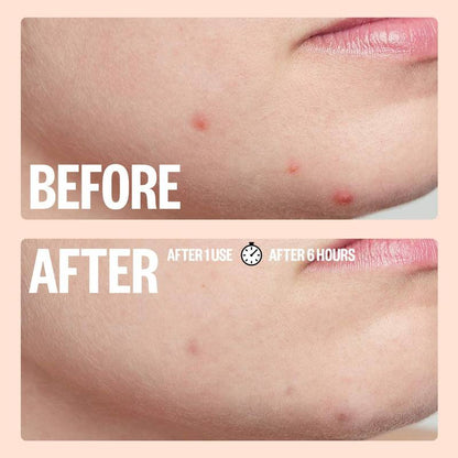 Peace Out Salicylic Acid Acne Healing Dots, 20ct